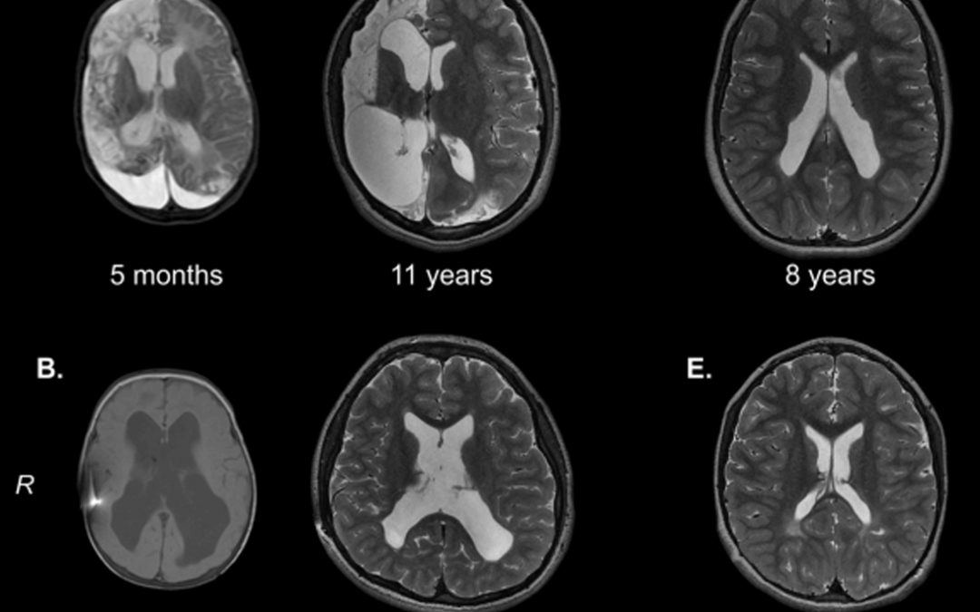 Long-term therapeutic effects of Katona therapy in moderate-to-severe perinatal brain damage